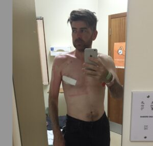 A mirror selfie of Phil post-mastectomy, with scaring on the right side of his chest and a bandage over his nipple.